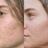 AHA Micro Exfoliator