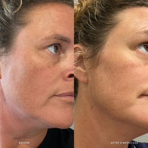 AHA Micro Exfoliator